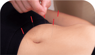 Specialized Acupuncture Top-Rated Acupuncture Services